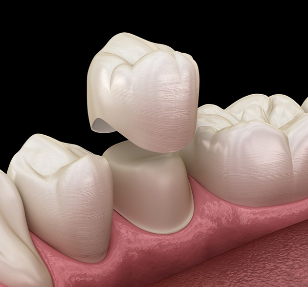 Dental crown placement illustration showing tooth restoration on gum model for cosmetic dentistry.