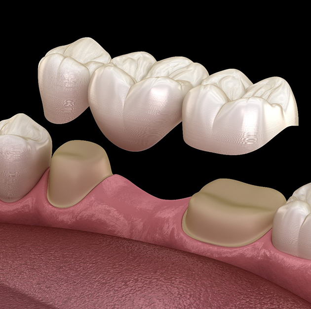 3D dental implant illustration showing tooth restoration with crown and bridge components on gum model.