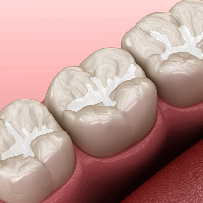 Three dental crowns on pink gum model showing tooth restoration and prosthetic dentistry work.