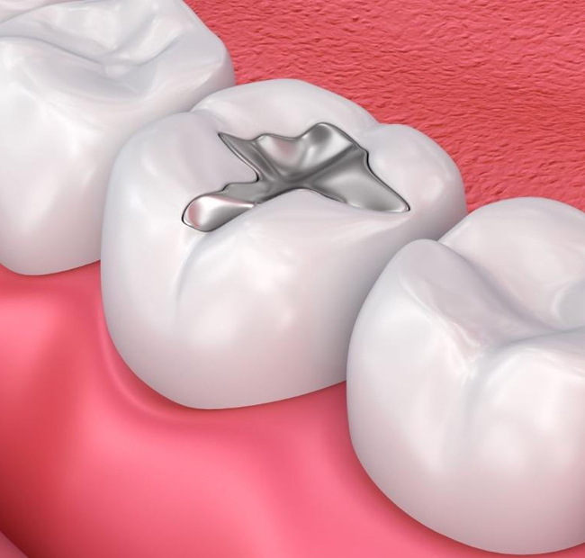 Dental cavity illustration showing decay inside a white tooth against pink gum background.