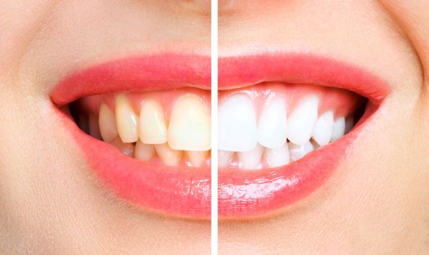 Teeth Whitening