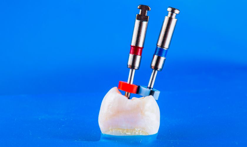 root canal treatment