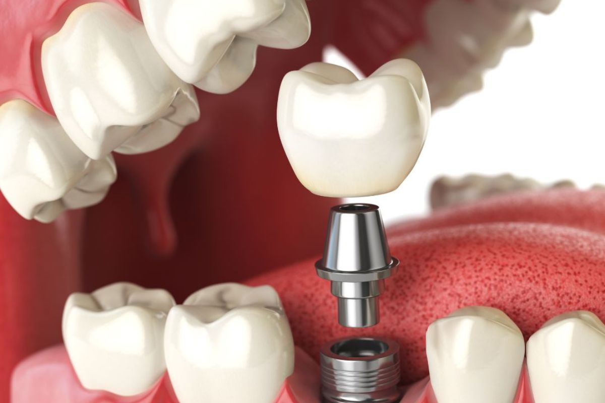 dental-implants-fletcher.jpg